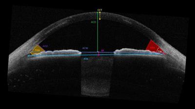 Swept-source optical coherence tomography in ocular surface diseases: anterior segment analysis repeatability and its limits